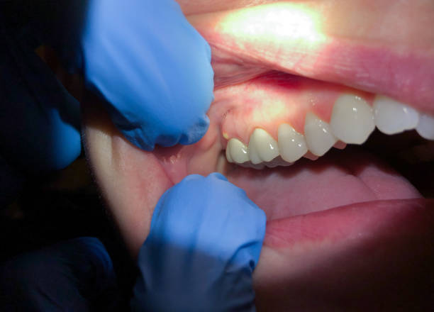 Best Emergency Tooth Extraction in Hastings, MI